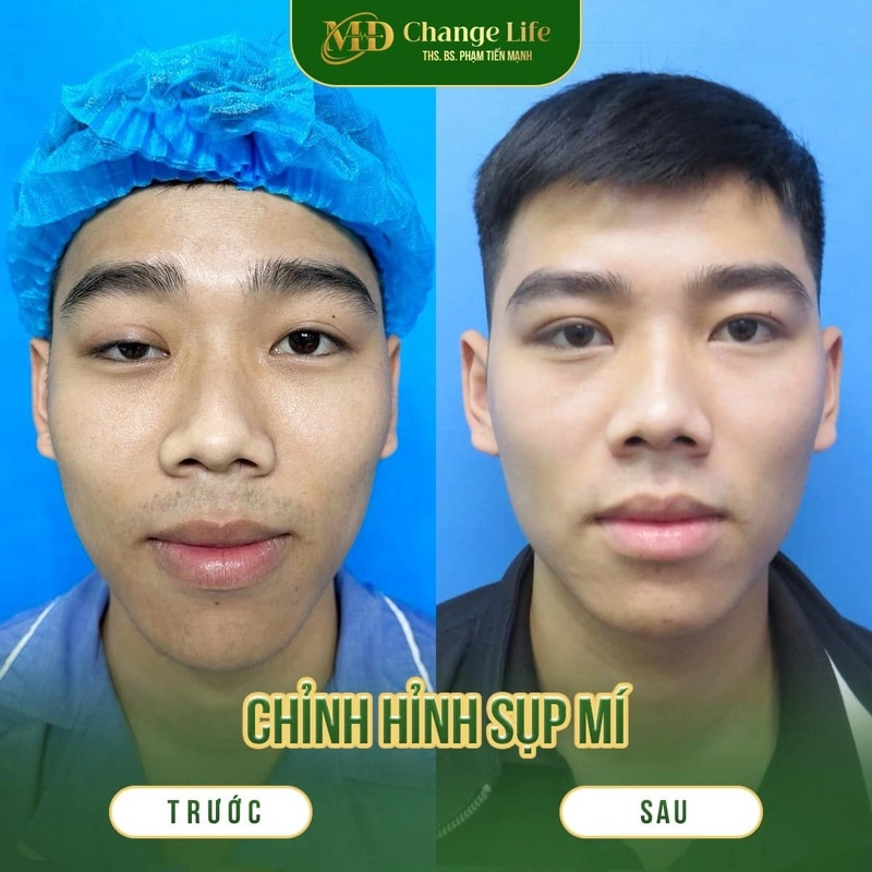 Top 6 Địa Chỉ Chỉnh Hình Sụp Mí Hà Nội