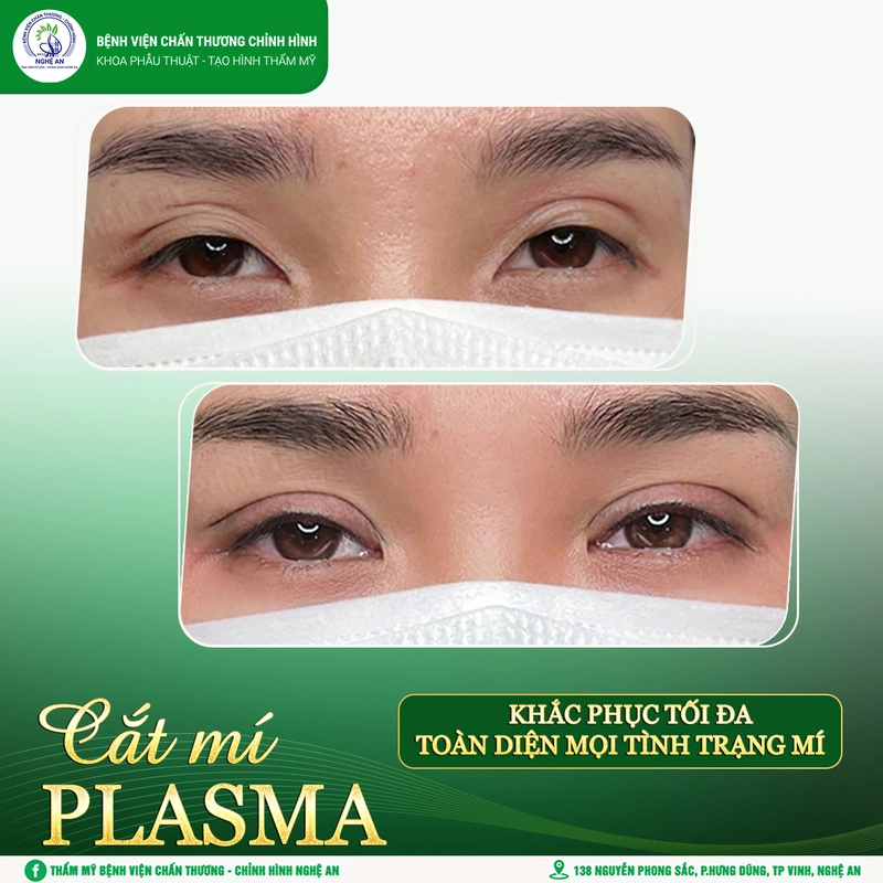 Tạo mắt 2 mí tại Bệnh viện Chấn thương chỉnh hình Nghệ An - Khoa Phẫu thuật tạo hình thẩm mỹ (Nguồn: Bệnh viện Chấn thương chỉnh hình Nghệ An - Khoa Phẫu thuật tạo hình thẩm mỹ)