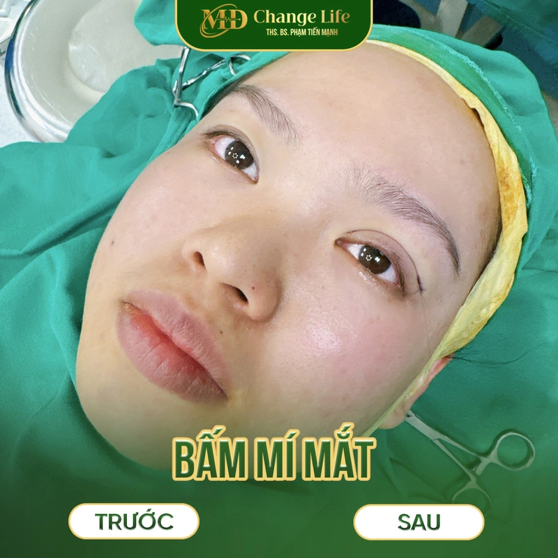 Hiệu quả khi thực hiện bấm mí đa điểm tại Thẩm Mỹ MD Change Life (Nguồn: Thẩm Mỹ MD Change Life)