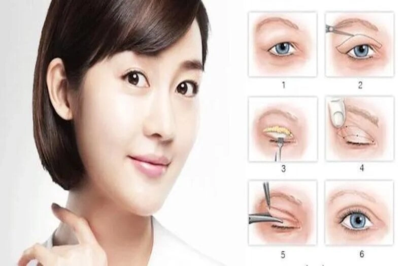Cắt mí mắt là phương pháp làm đẹp phổ biến (Nguồn: Internet)