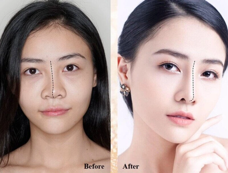 Sửa mũi nâng hỏng là vấn đề đang hot (Nguồn: Internet)