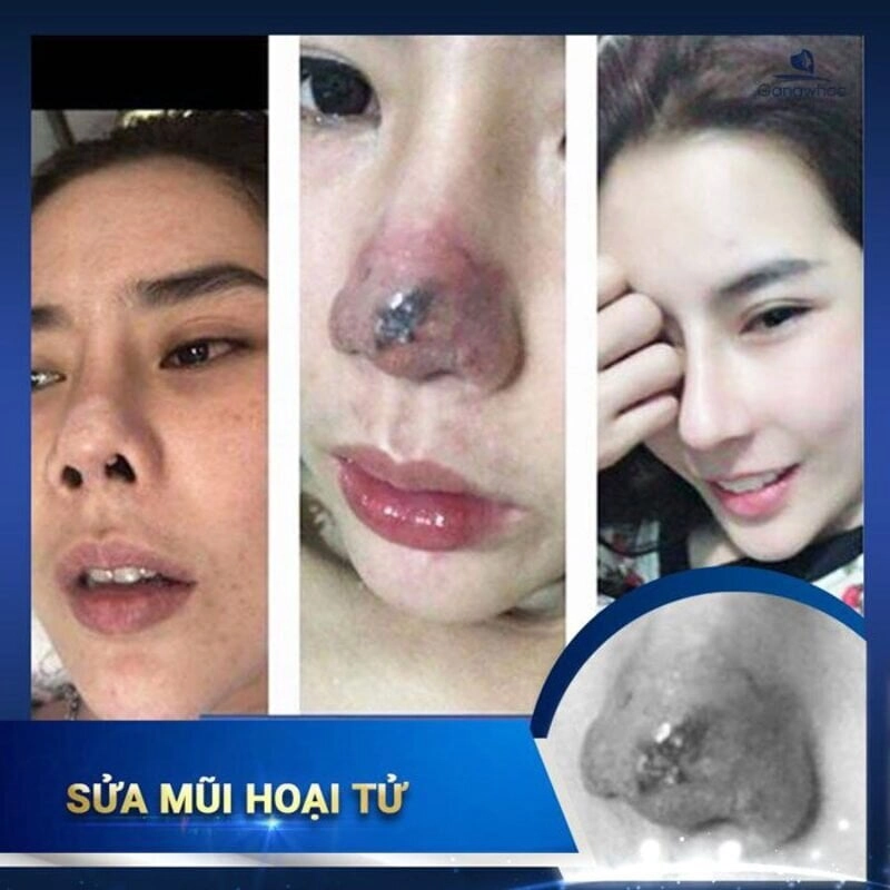 Sửa mũi biến chứng hoại tử (Nguồn: Internet)
