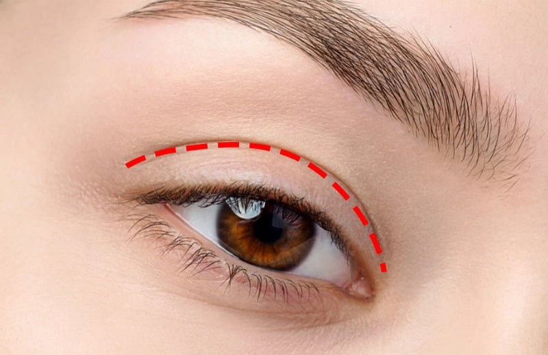 Bấm mí đa điểm mang lại nhiều hiệu quả tuyệt vời về mặt thẩm mỹ (Nguồn: Internet)