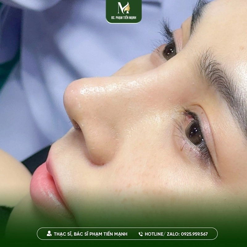 Cải thiện thẩm mỹ với dáng mũi hài hòa (Nguồn: MD Change Life)