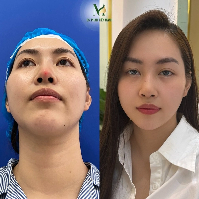 Nâng Mũi Cấu Trúc Có Bị Tụt Sụn Không? Sự Thật Cần Biết