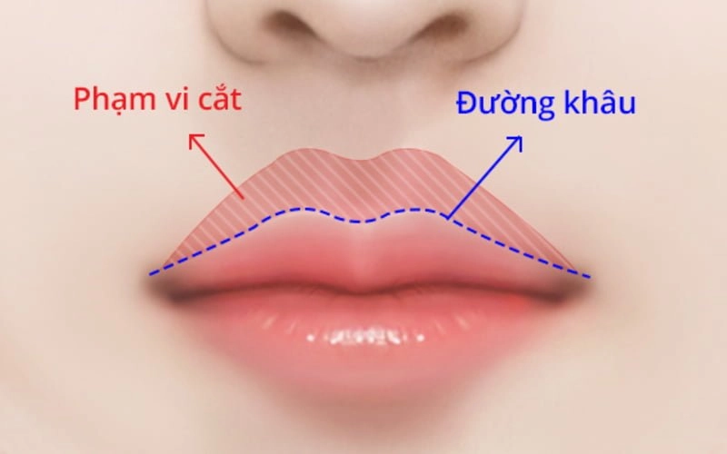 Phẫu thuật thu ngắn nhân trung là gì? (Nguồn: Internet)