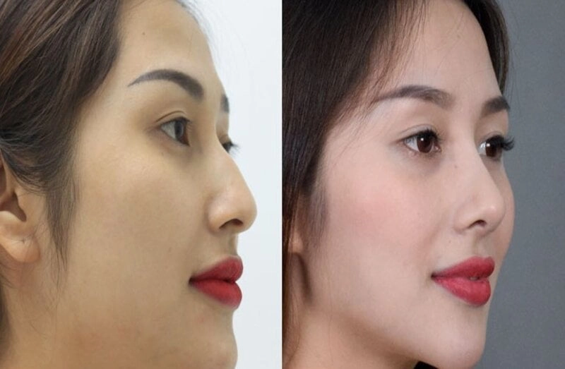 Chỉnh dáng mũi gồ tại MD Change Life - Viện thẩm mỹ uy tín tại Hà Nội (Nguồn: Internet)