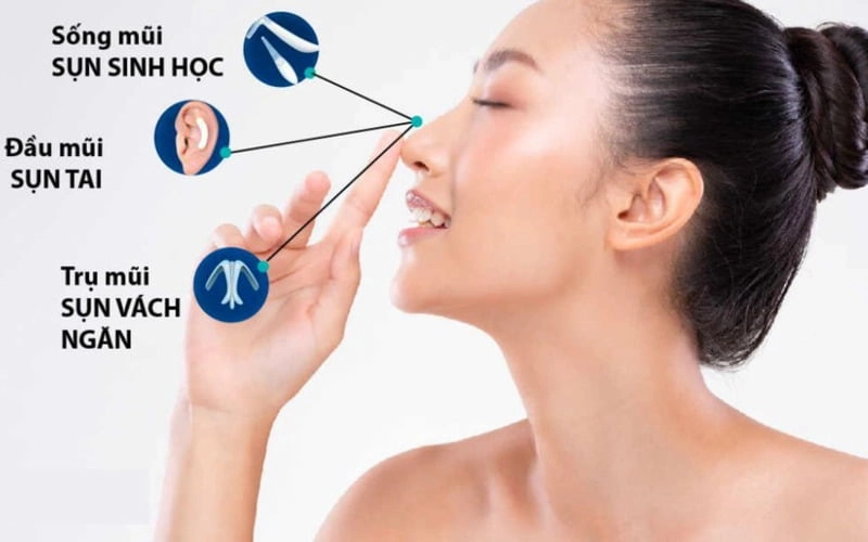Cấy ghép sụn, chỉnh hình mũi (Nguồn: Internet)