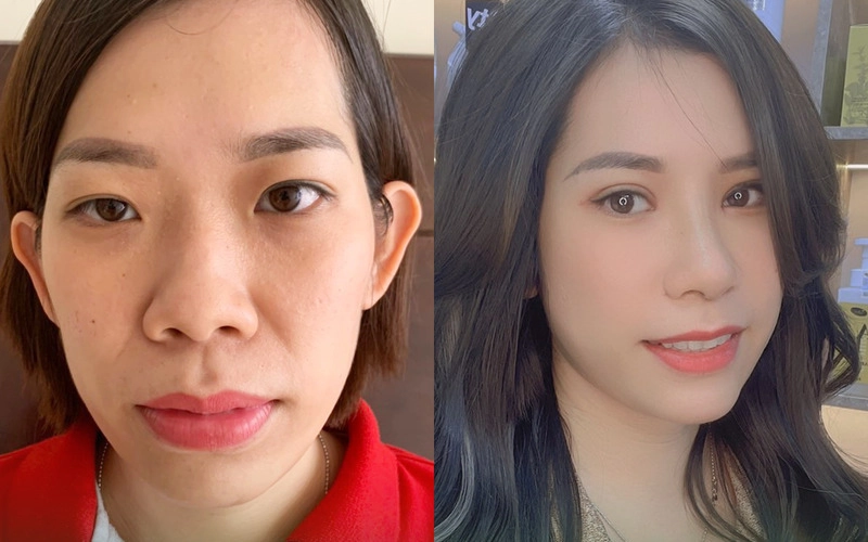 Top 6 địa chỉ cấy mỡ mặt Hà Nội tốt nhất