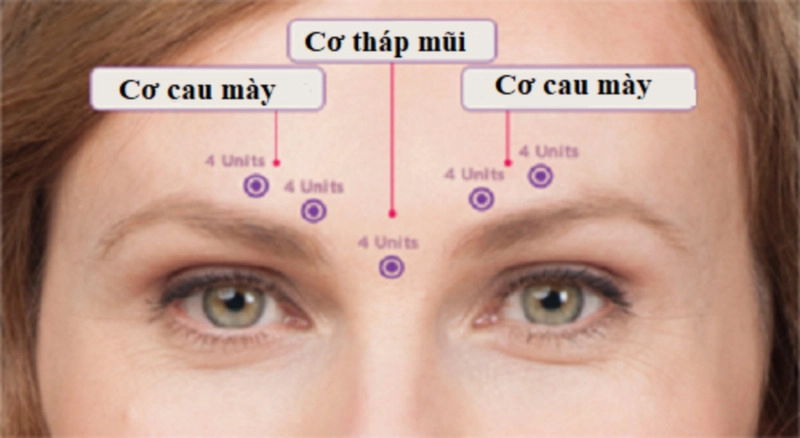 Tiêu chí lựa chọn địa chỉ cắt cơ cau mày Hà Nội uy tín (Nguồn: Internet)