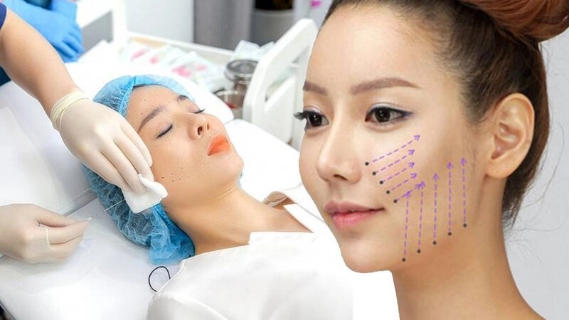 Căng chỉ trẻ hoá gương mặt - Phương pháp làm đẹp được ưa chuộng (Nguồn: Internet)