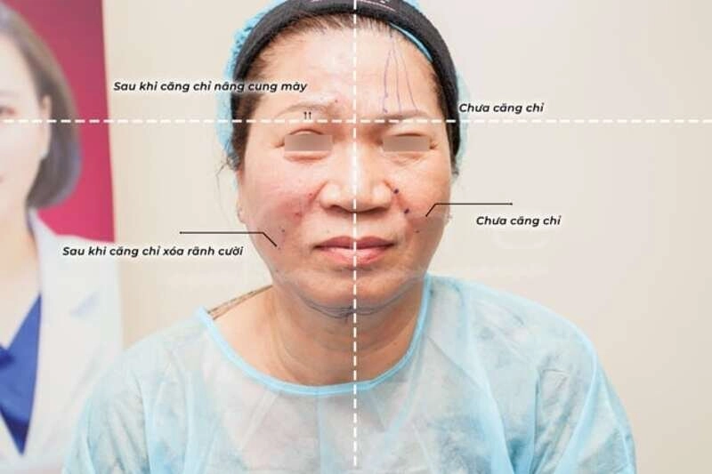Đánh bay nếp nhăn bằng cách căng chỉ trẻ hoá gương mặt (Nguồn: Internet)