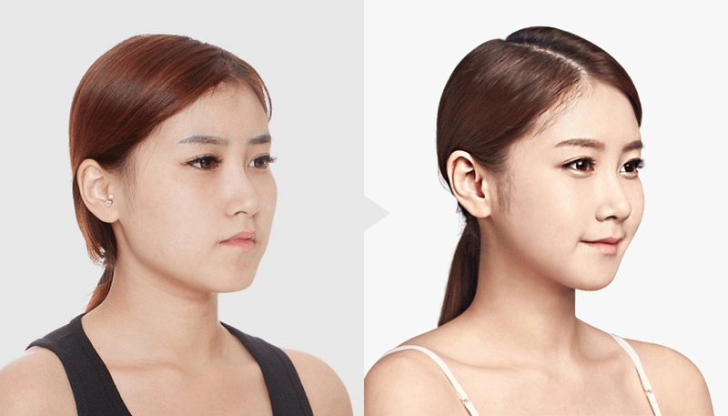 Có nên tiêm gọn hàm không? Lời khuyên từ chuyên gia
