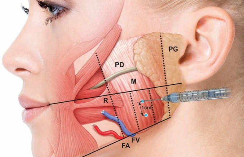 Cơ chế hoạt động của Botox trong việc thon gọn hàm (Nguồn: Internet)
