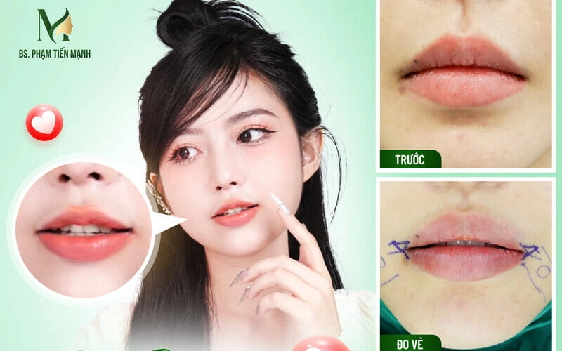 Cách tiêm tạo khoé môi xinh