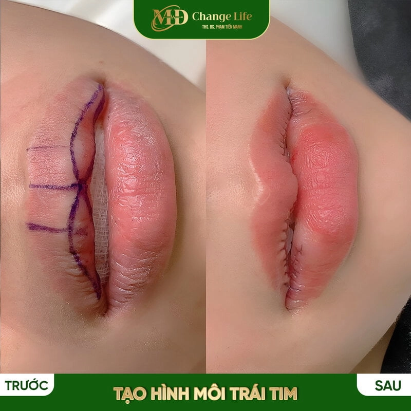 Tiêm filler tạo hình môi trái tim tại Thẩm mỹ MD Change Life (Nguồn: MD Change Life)