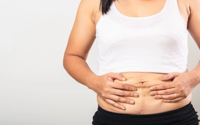 Hút mỡ tạo hình thành bụng: Chìa khóa cho vòng 2 thon gọn