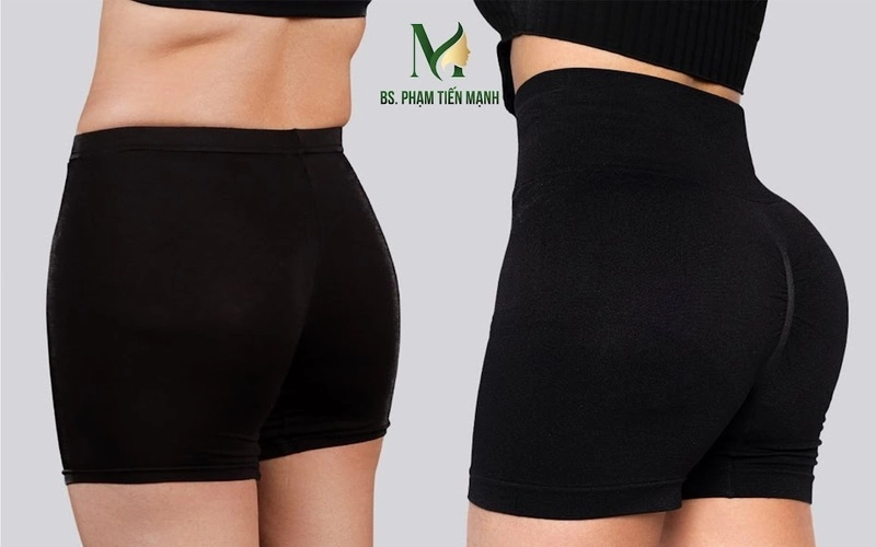 Nâng mông tại Thẩm mỹ MD Change Life (Nguồn: MD Change Life)