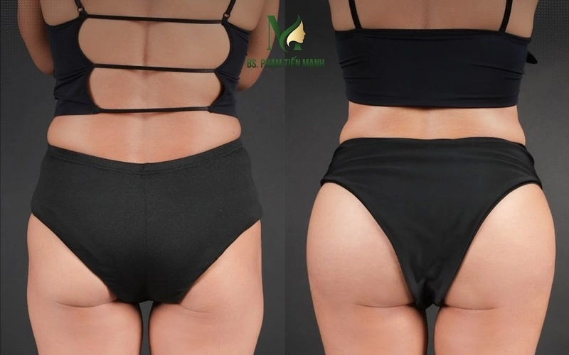 Nâng Mông Nội Soi – Bí Quyết V3 Quyến Rũ