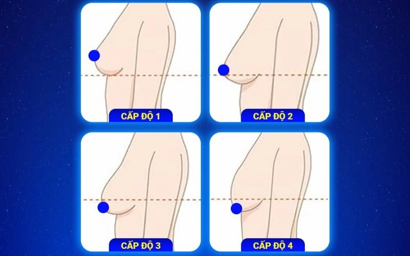 Các độ sa trễ ngực (Nguồn: Internet)