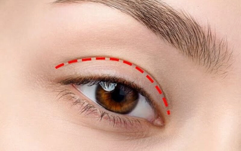Cắt mí là tiểu phẫu tạo ra một nếp gấp chính là mí mắt mới đối với mí mắt trên (Nguồn: Internet)