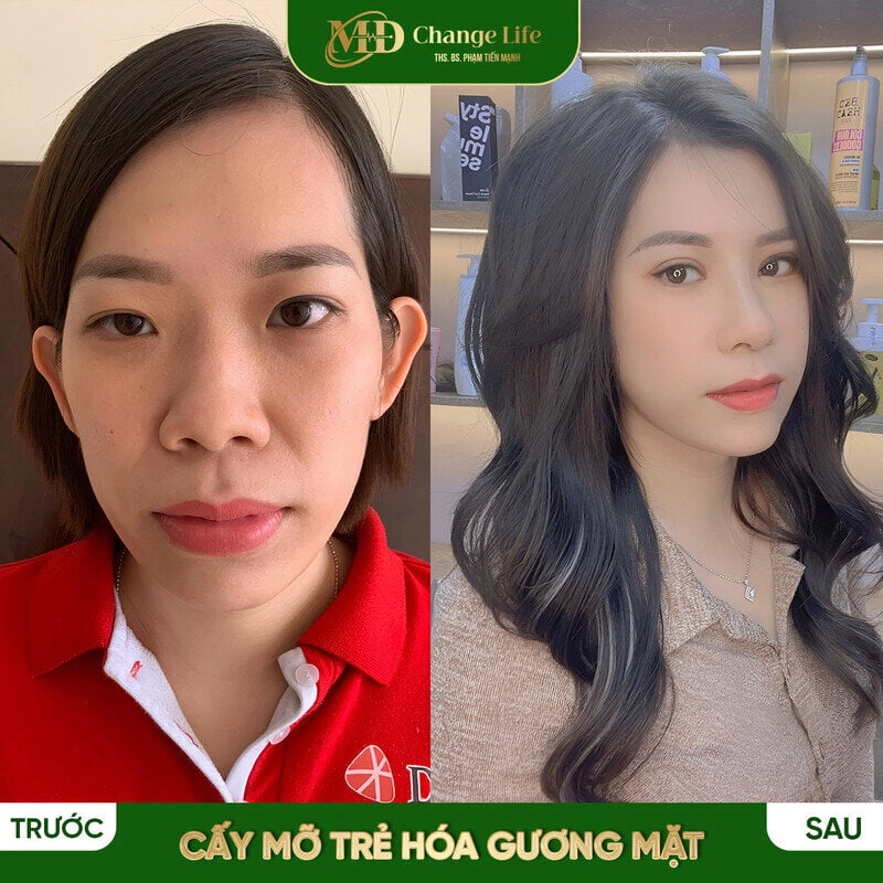 Trước và sau khi trẻ hóa gương mặt tại MD Change Life (Nguồn: MD Change Life)