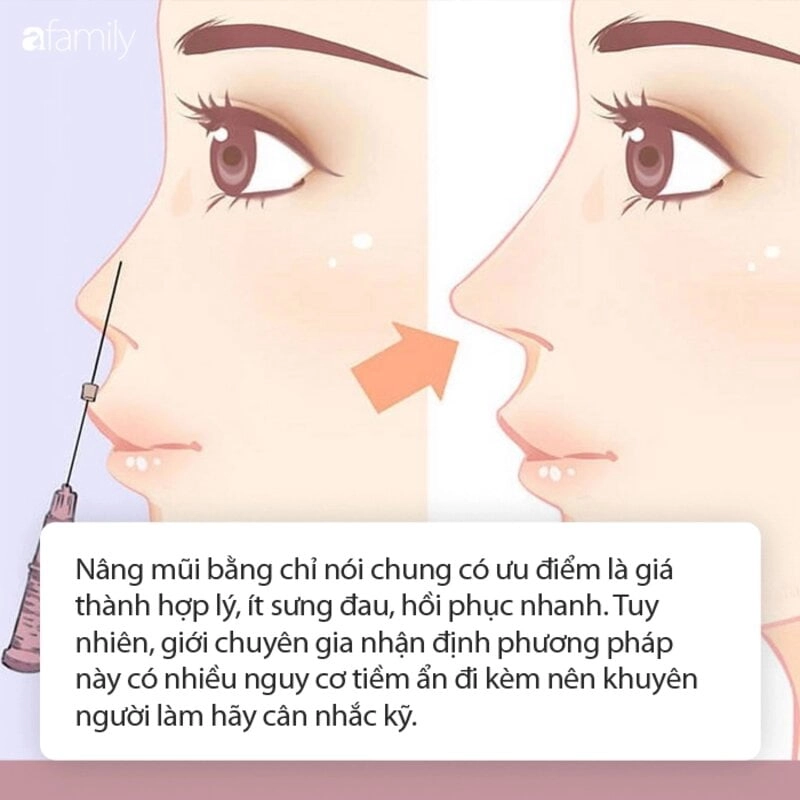 Phương pháp nâng mũi này có rất nhiều ưu điểm (Nguồn: Internet)