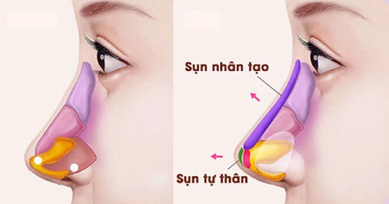 Nâng mũi bán cấu trúc là phương pháp tối ưu (Nguồn: Internet)