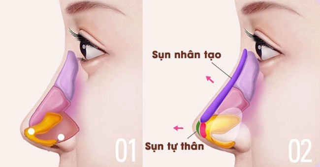 Nâng mũi sụn tự thân là gì? (Nguồn: Internet)