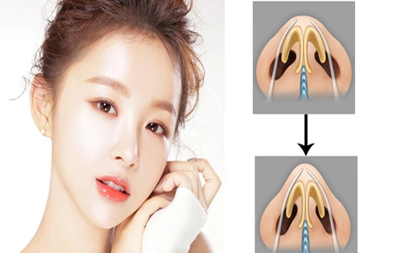 Nâng mũi bọc sụn là như thế nào? (Nguồn: Internet)