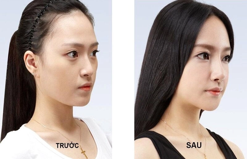 Đánh bay sự tự ti của các chị em không ưng ý mũi của mình (Nguồn: Internet)