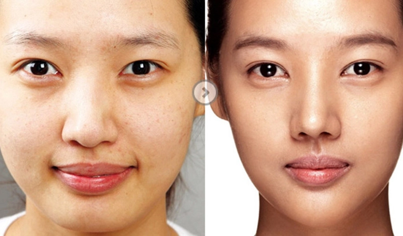 Nâng mũi đẹp tự nhiên: Bí quyết sở hữu dáng mũi hoàn hảo