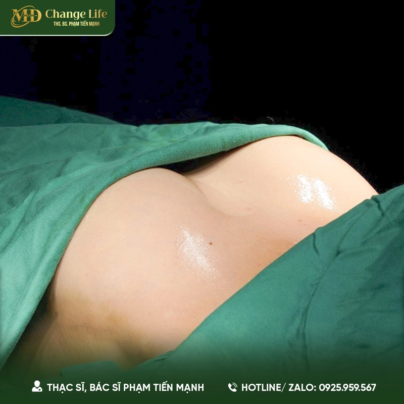 Nâng ngực size 350 là gì? (Nguồn: Thẩm Mỹ MD Change Life)