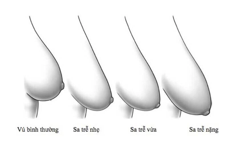 Các mức độ sa trễ ở phụ nữ (Nguồn: Internet)