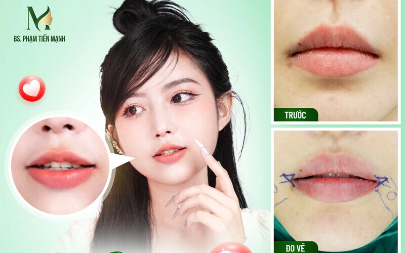 Tạo khóe môi cười rạng rỡ tại Thẩm Mỹ MD Change Life (Nguồn: Thẩm Mỹ MD Change Life)