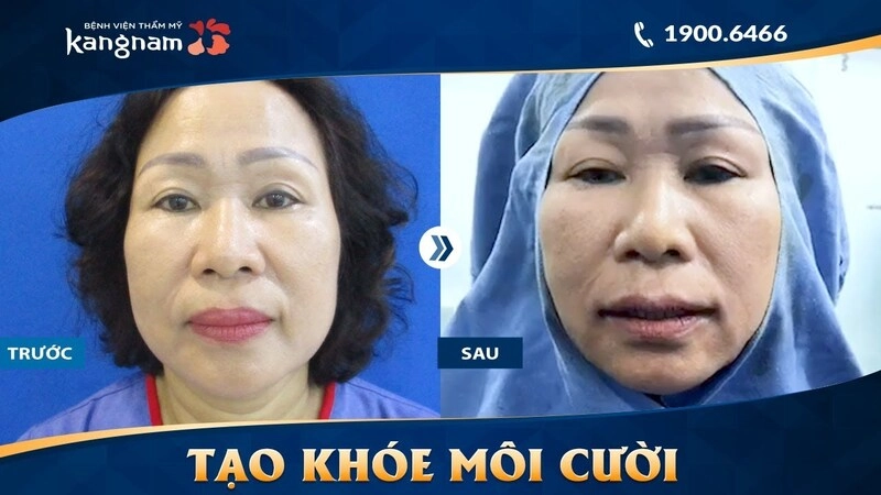 Dịch vụ tạo khóe môi cười tại Bệnh viện Thẩm mỹ Kangnam (Nguồn: Internet)
