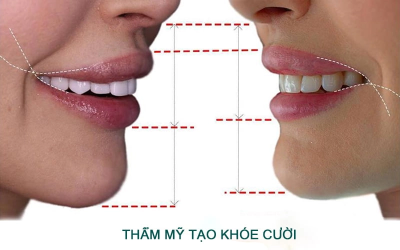 Cách có khóe miệng cười rạng rỡ, tươi tắn
