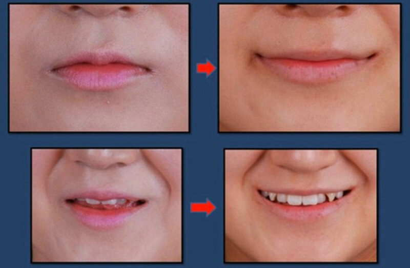 Phương pháp tạo khoé miệng cười là như thế nào? (Nguồn: Internet)
