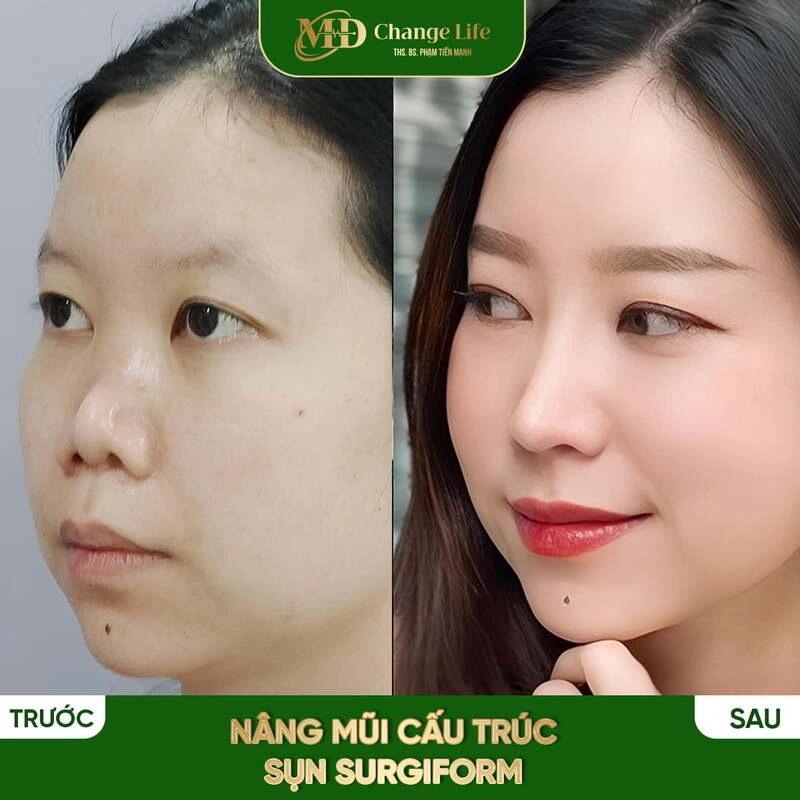 Hình ảnh khách hàng nâng mũi thành công tại MD Change Life (Nguồn: MD Change Life)