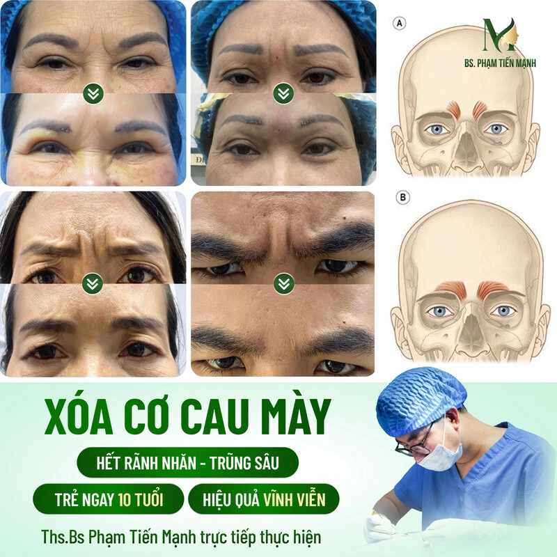 Thẩm Mỹ MD Change Life - Nơi tiêm xóa nhăn cau mày uy tín hàng đầu (Nguồn: MD Change Life)