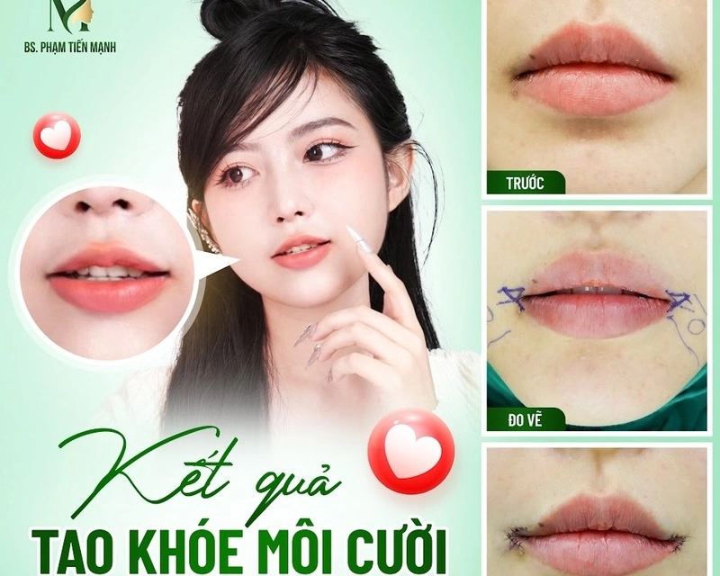 Làm khoé miệng cười tại Thẩm mỹ MD Change Life (Nguồn: MD Change Life)