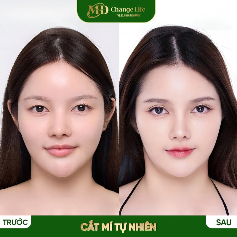 Dịch vụ cắt mí dưới an toàn tại Thẩm Mỹ MD Change Life (Nguồn: Internet)