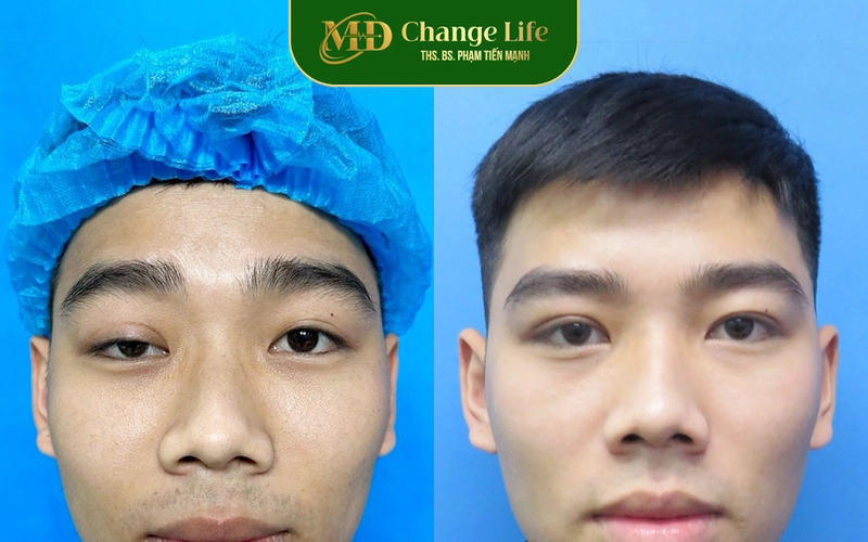 Sửa mí hỏng tại Thẩm mỹ MD Change Life (Nguồn: MD Change Life)