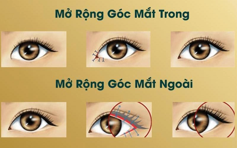 Top 5 Địa Chỉ Cắt Mí Mở Góc Mắt Hà Nội Uy Tín