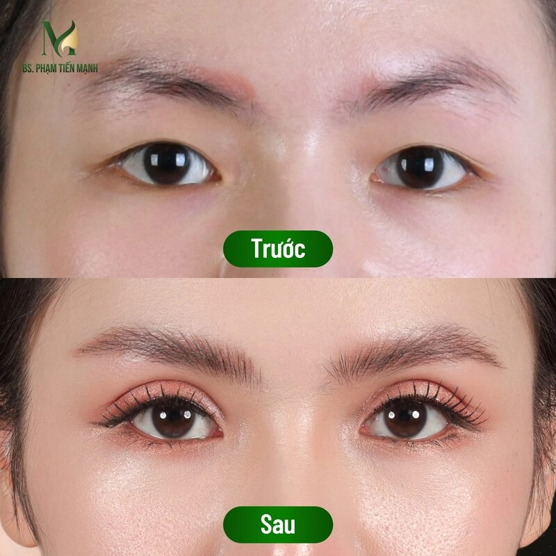 Top 5 Địa Chỉ Cắt Mí Mở Góc Mắt Hà Nội Uy Tín