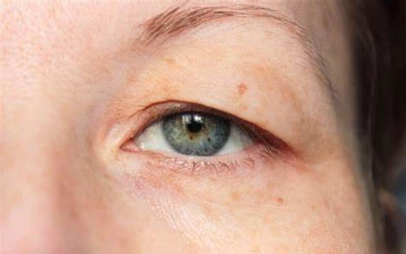 Top 6 Địa Chỉ Chỉnh Hình Sụp Mí Hà Nội