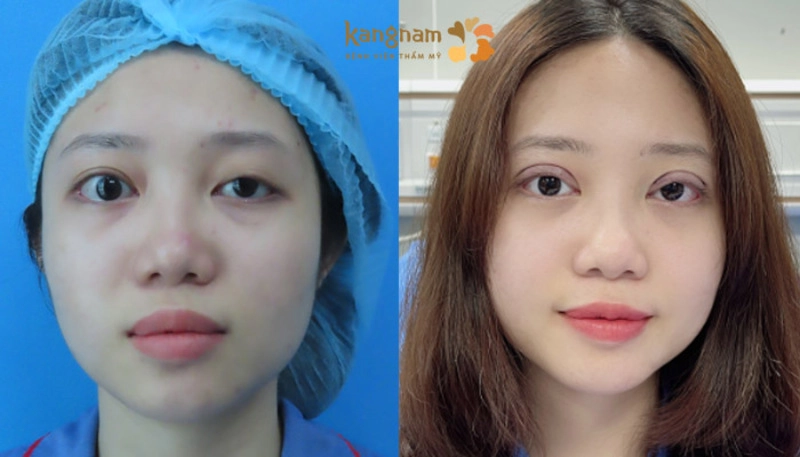 Chỉnh hình sụp mí tại Bệnh viện Thẩm mỹ Kangnam (Nguồn: Bệnh viện Thẩm mỹ Kangnam)