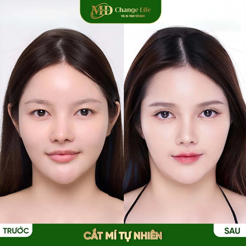 Hình ảnh khách hàng sử dụng dịch vụ thẩm mỹ mắt taị MD Change Life ( Nguồn: MD Change Life )