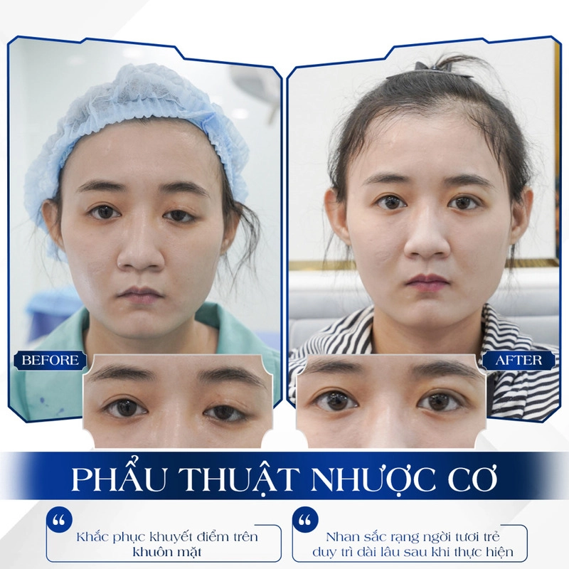 Dùng phương pháp phẫu thuật cải thiện nhược cơ ( Nguồn: Internet )