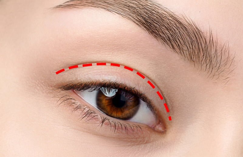 Bấm mí đa điểm mang lại nhiều hiệu quả tuyệt vời về mặt thẩm mỹ (Nguồn: Internet)